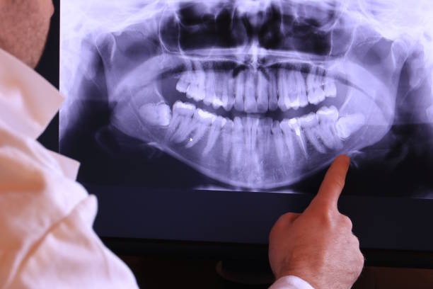 Best Emergency Wisdom Teeth Removal in Chicago, IL
